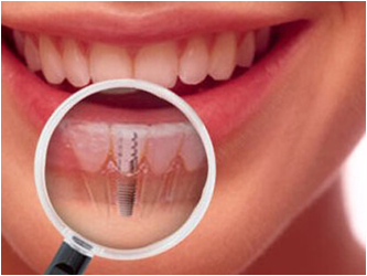 En iyi implant hangisi? Kaliteli İmplant kriterleri ankara diş sincan